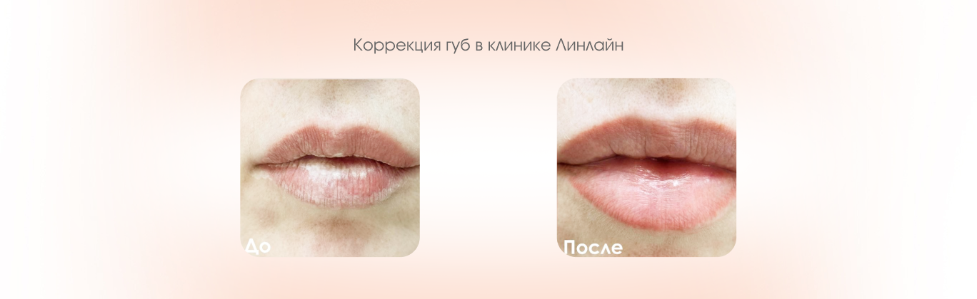 Лазерное омоложение губ