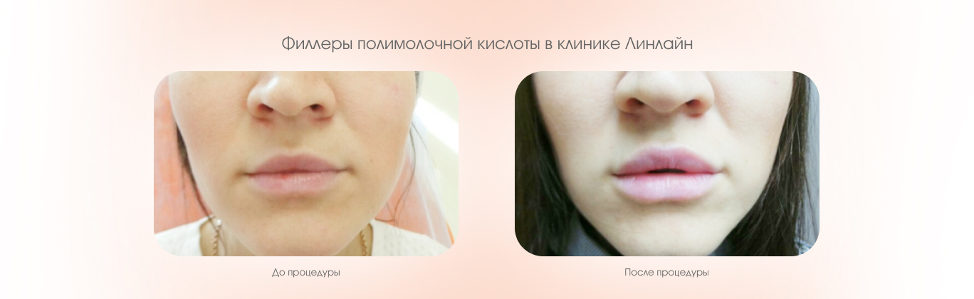 Филлеры