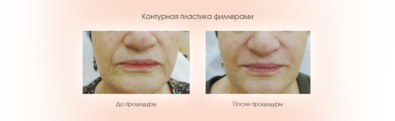 Контурная пластика филлерами