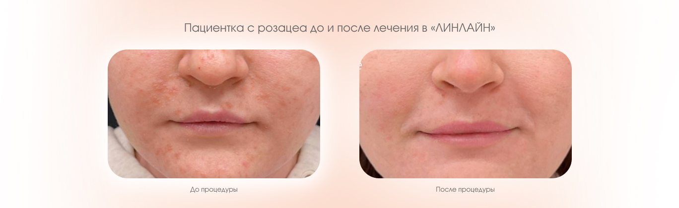 Розацеа