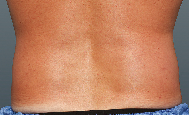 CoolSculpting-скульптор фигуры после процедуры