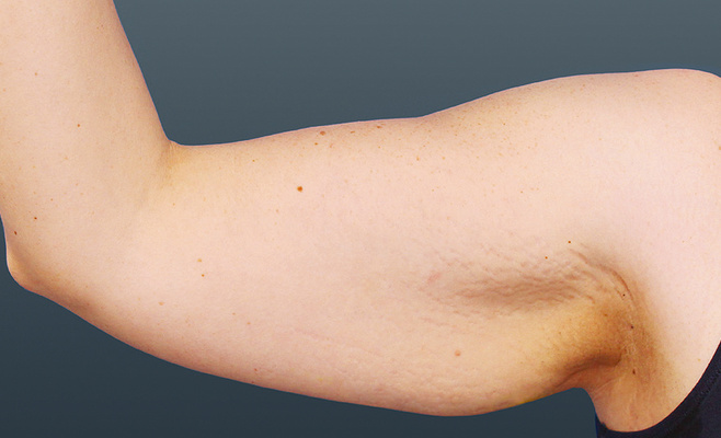 CoolSculpting-руки до процедуры